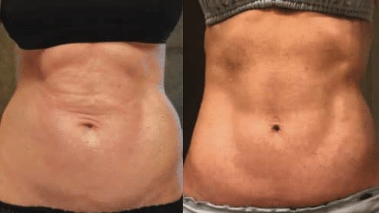 bodytite abdomen before after 2