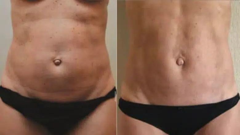 bodytite & Morpheus8 stomach before after