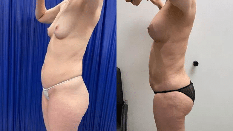 Putting Stubborn Fat to Use: See What a Fat Transfer to the Hips Can Achieve