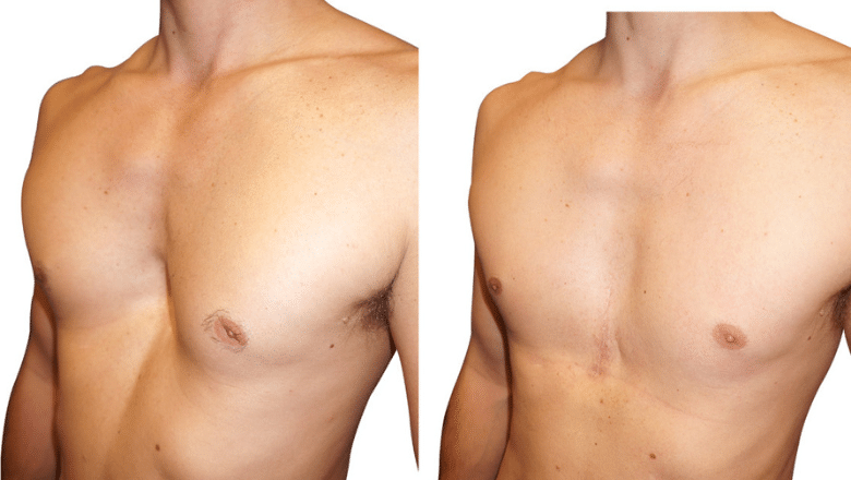 pectus excavatum custom implants before after 2