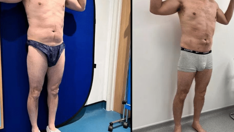 male calf implant results before after 2