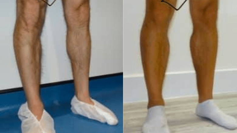 Calf Implant Recovery: Tips for Optimal Results