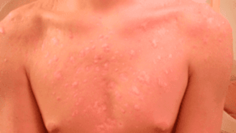 chest acne laser treatment after