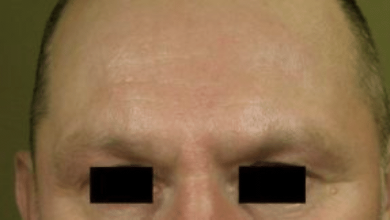 forehead laser rosacea treatment
