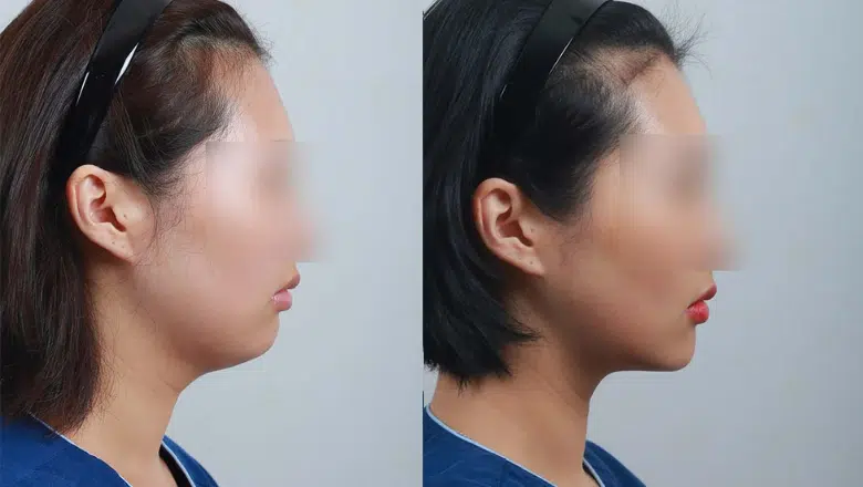 submental liposuction before after