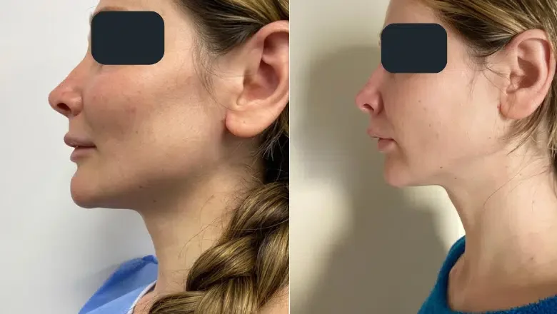 upper lip lift before after side view