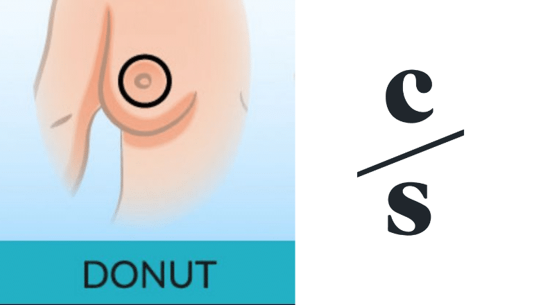 doughnut incision