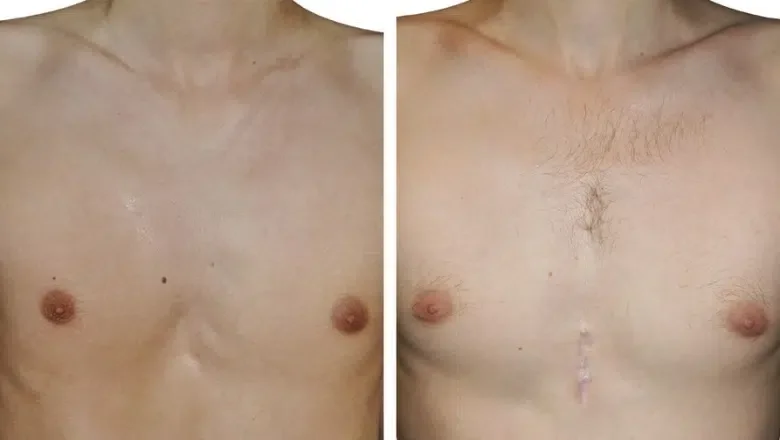 pectus implants before after 3