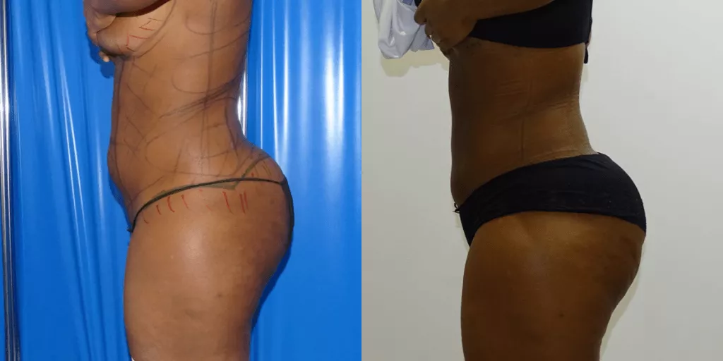 360 liposuction before and after side view