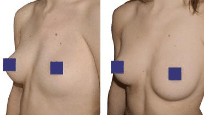 Breast Asymmetry - Harley Clinic