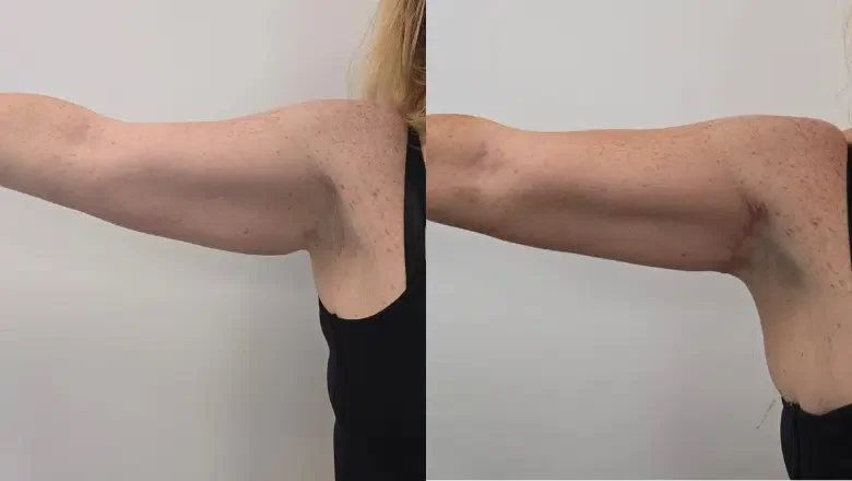 mini arm lift before and after