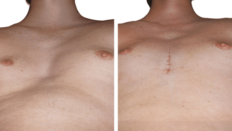 NewTampaPlasticSurgery on X: Tired of working out your pecs and not seeing  the results you want? We can help! Pectoral implant surgery is an excellent  option for men who desire a fuller