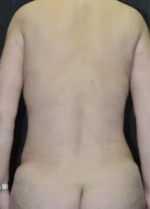 bodytite lipo after