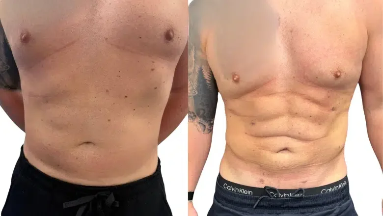 Abdominal Etching 6 pack before after