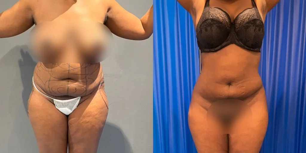 large bmi bbl before and after