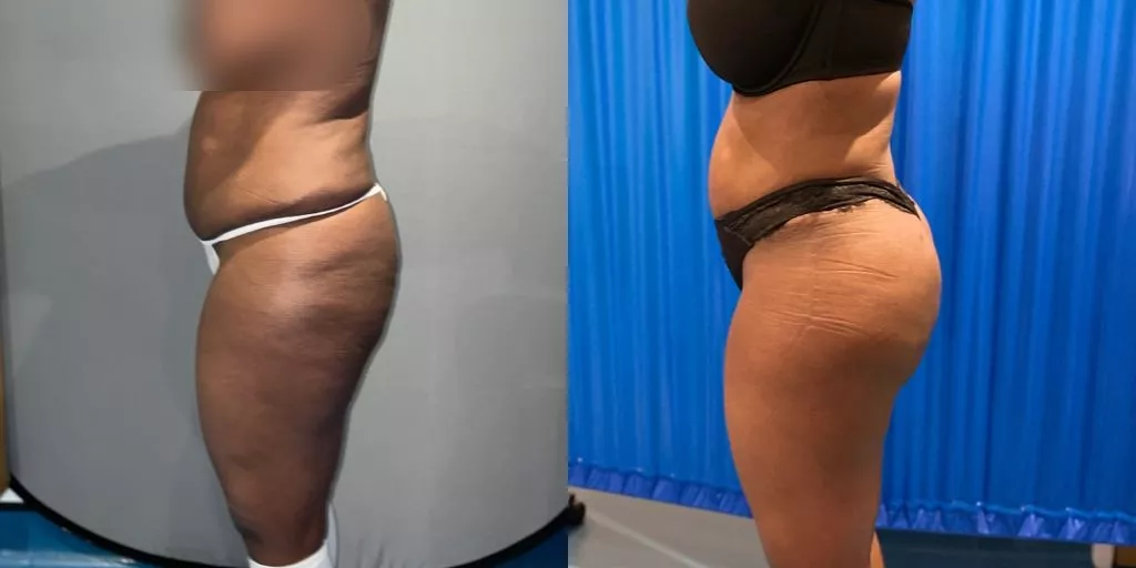 Brazilian Butt Lift Before And After: Double the Benefits - Destin