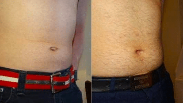 Belly button correction before and after