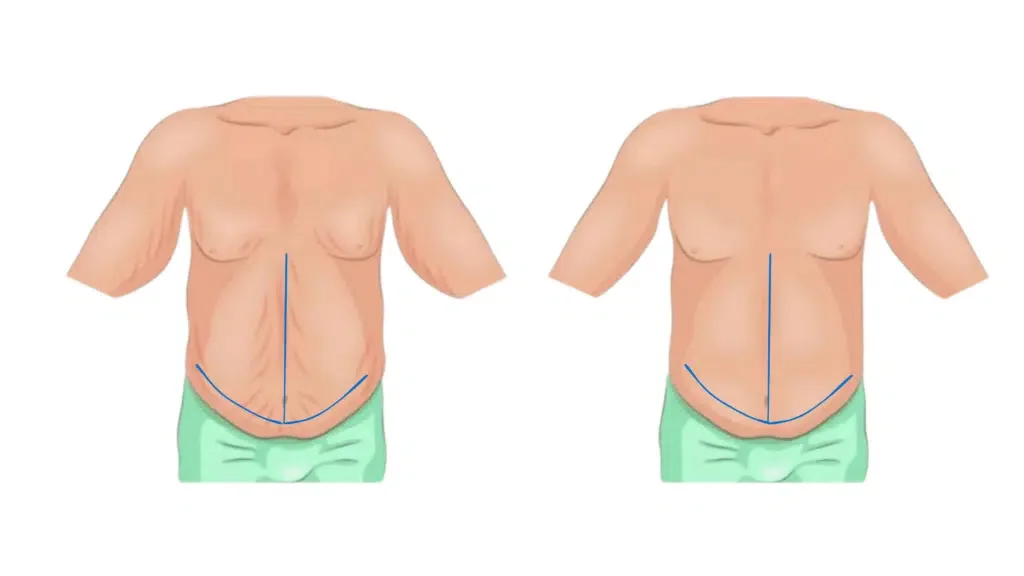 Fleur de Lis Tummy tuck Incision Procedure London UK