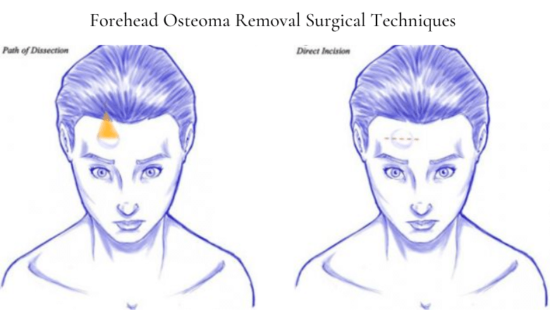 Forehead osteoma removal surgical techniques
