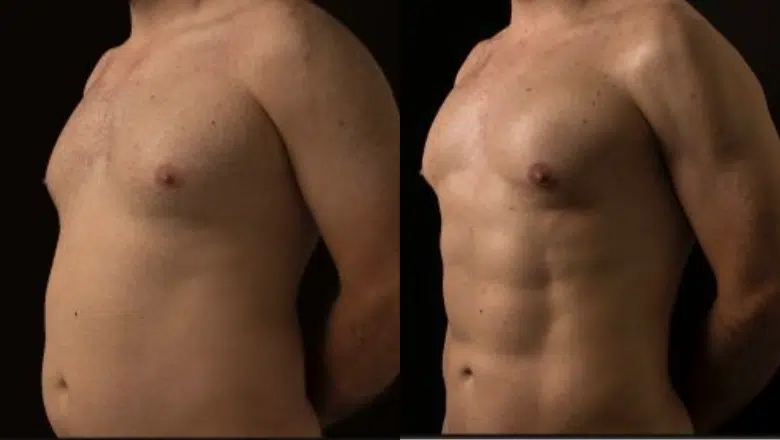 HD lipo before after