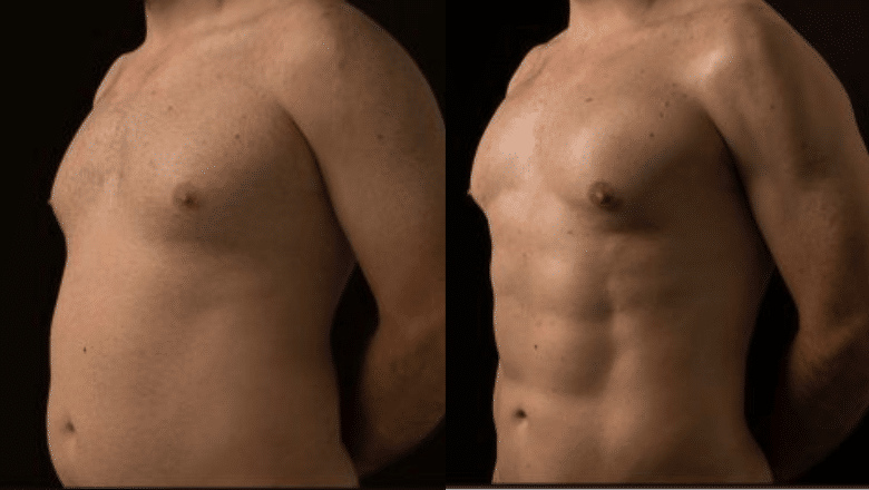 HD lipo before after