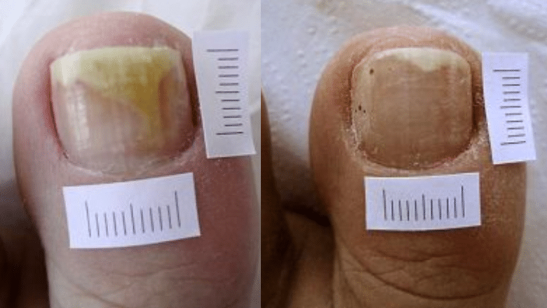 Laser Fungal Nail Treatment Before After