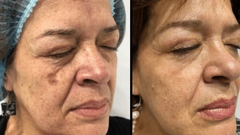Laser Seborrhoeic Keratosis Removal before after