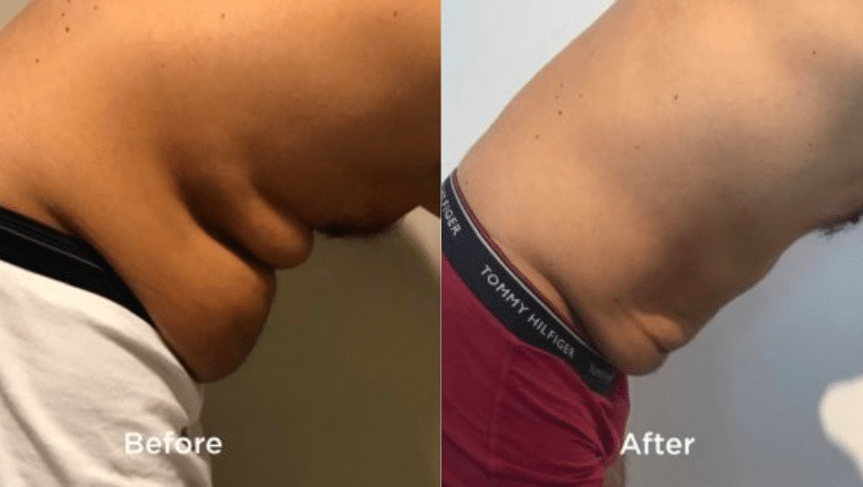 Male TightSculpting Before & After