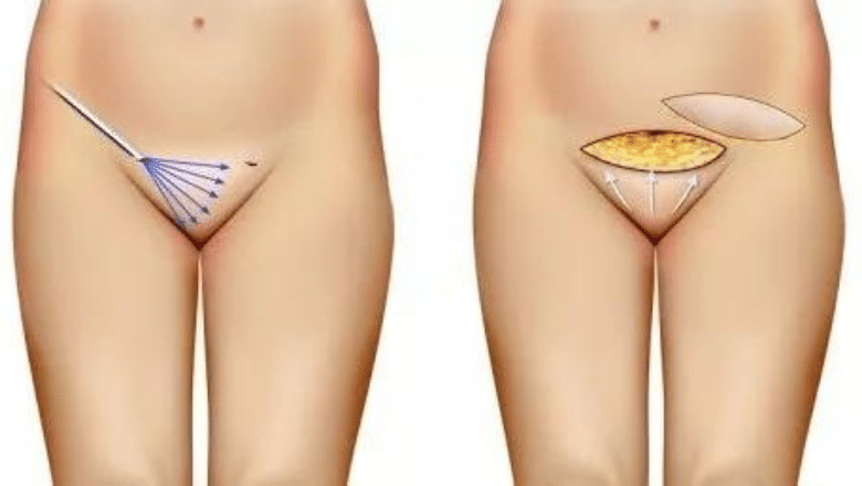 Tummy Tuck with Hernia Repair, Pubic Lift and Liposuction of the Mons Pubis.  
