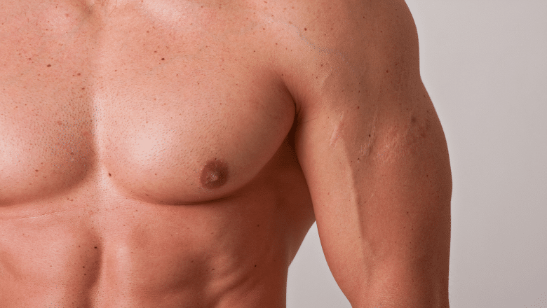 Pectoral Implants London UK