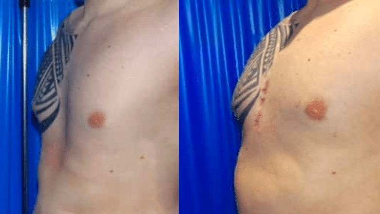 Pectus excavatum custom implant before after 1