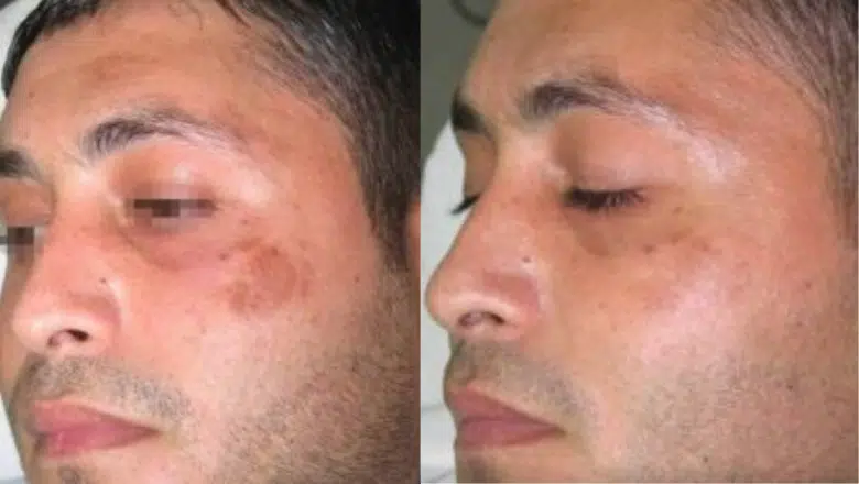 Post-inflammatory-hyperpigmentation-before-after.png.webp?format=webp&nv=212368fc-2000-40d1-9026-c0f94abda644