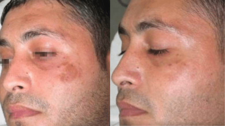 Post-inflammatory hyperpigmentation before after