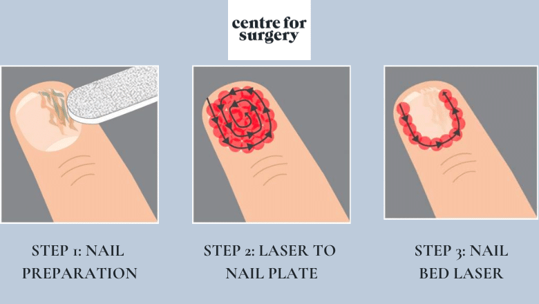 Step-by-Step Fungal Nail Laser Treatment Procedure