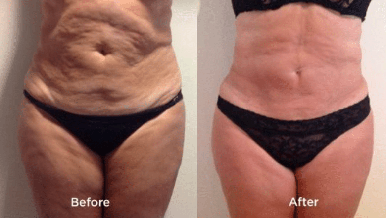 TightSculpting abdomen Before & After