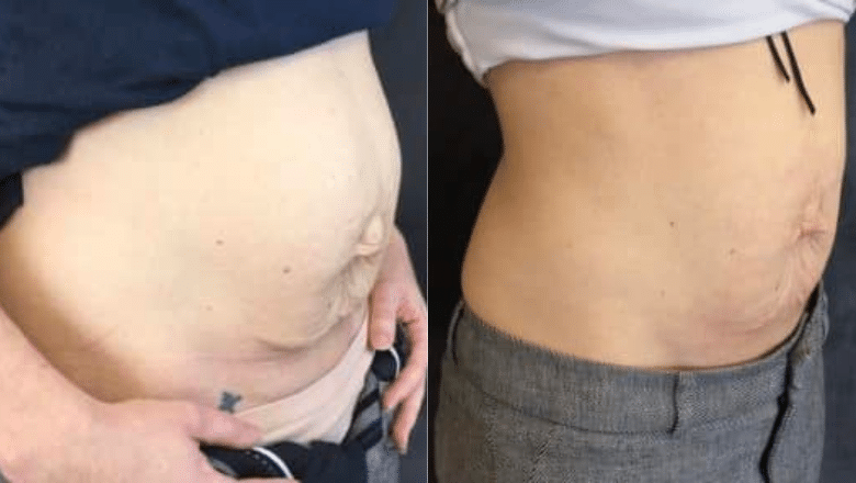 TightSculpting after pregnancy Before & After