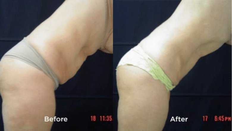 TightSculpting after pregnancy Before & After side view