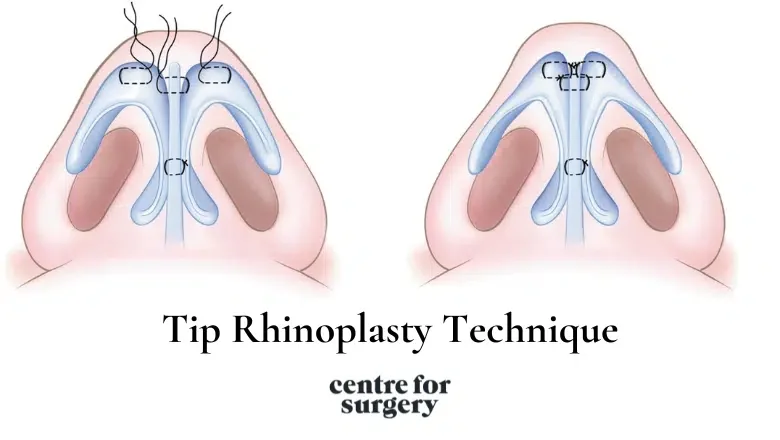 Tip Rhinoplasty Technique