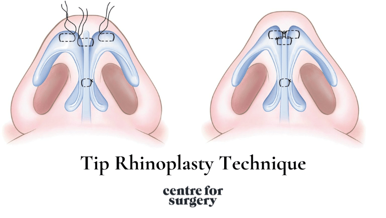 Tip Rhinoplasty Technique