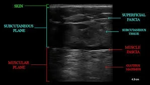 ultrasound guided BBL