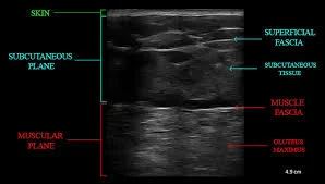 ultrasound guided BBL