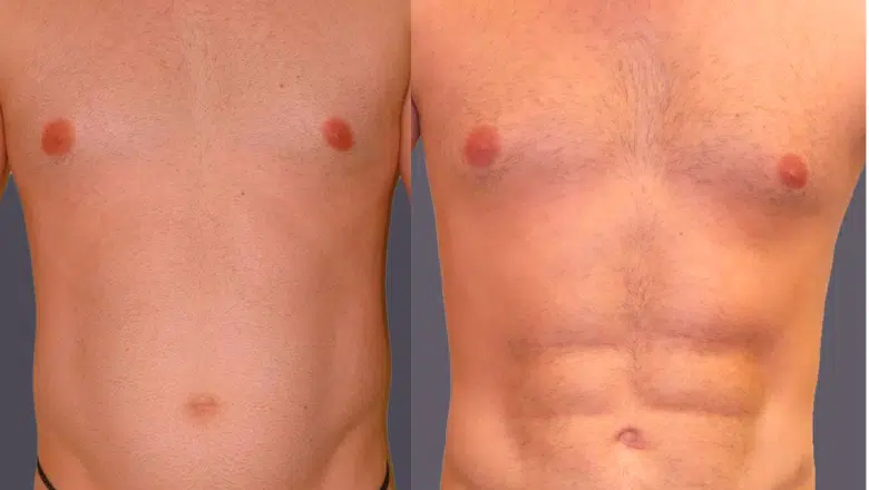 abdominal-etching-hd-lipo-before-and-after-3.png.webp?format=webp&nv=212368fc-2000-40d1-9026-c0f94abda644