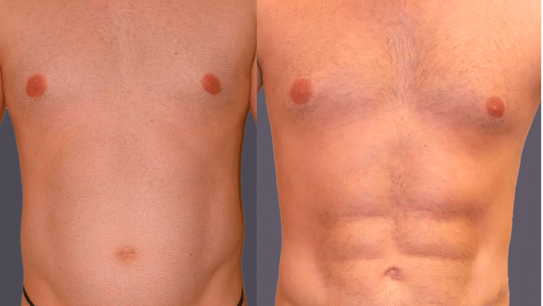 abdominal etching hd lipo before and after 3