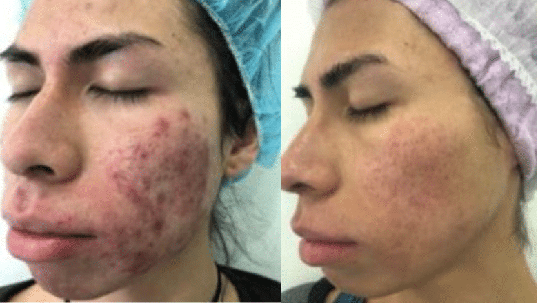 acne laser treatment before after
