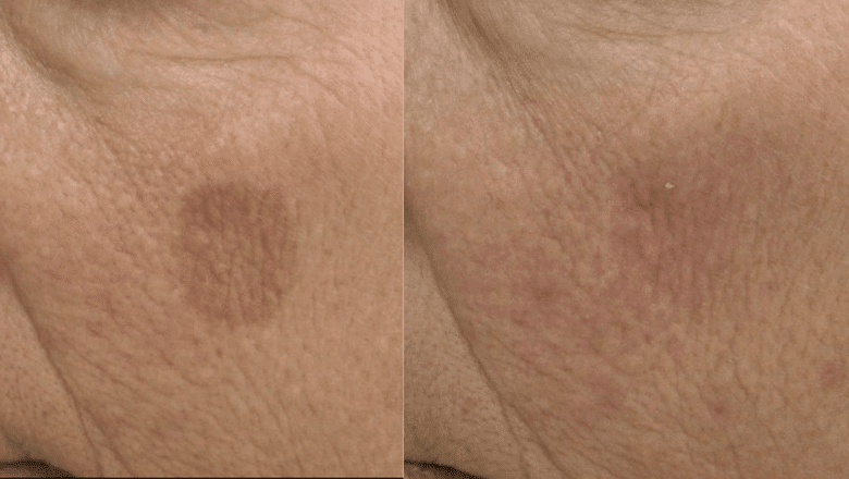 age spot removal before after