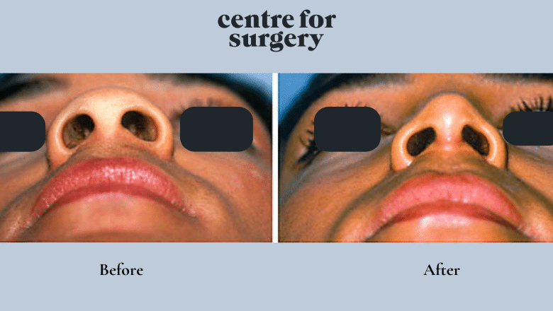 alarplasty before after 1