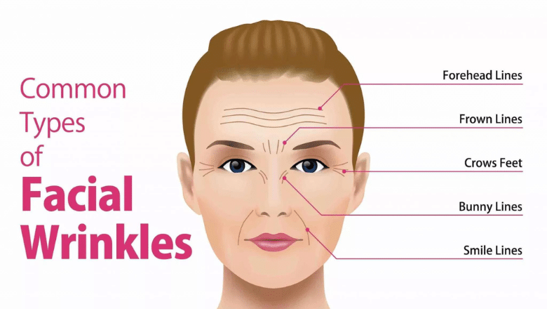 anti wrinkle injections common injection areas