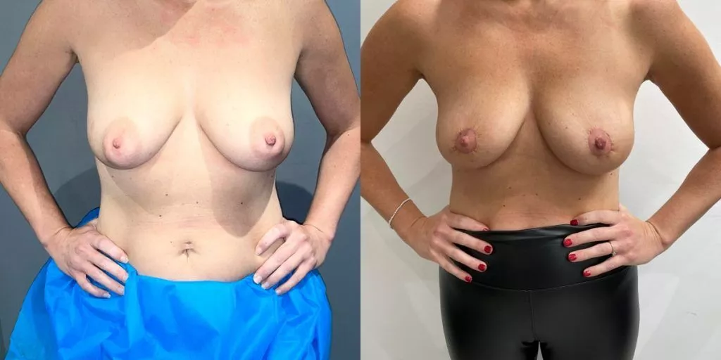 areola reduction before after photo