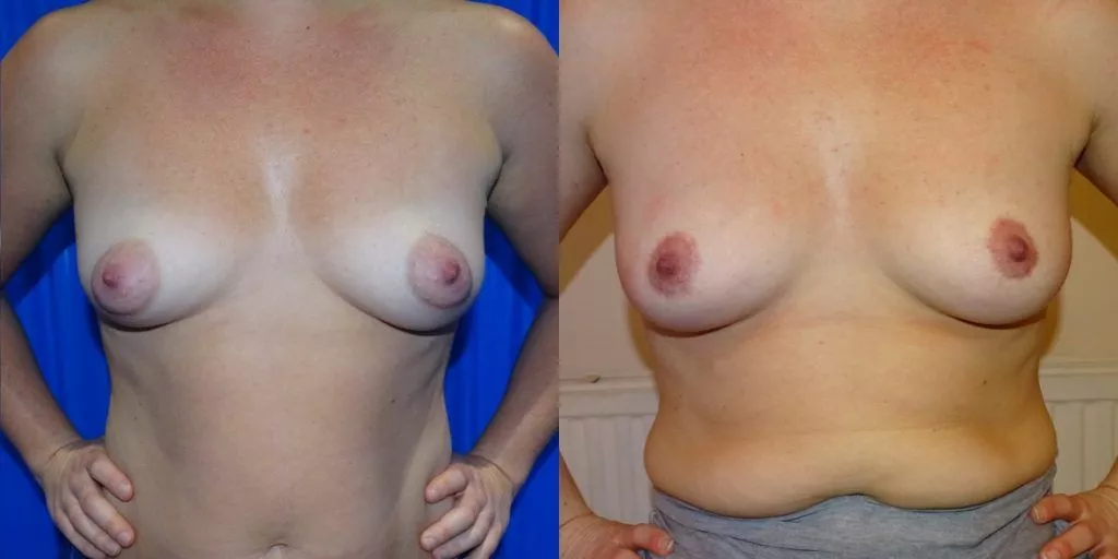 areola reduction results
