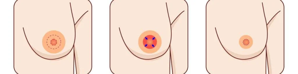 areola reduction surgery techniques